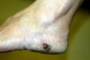 melanoma de pie