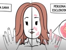 esclerodermia
